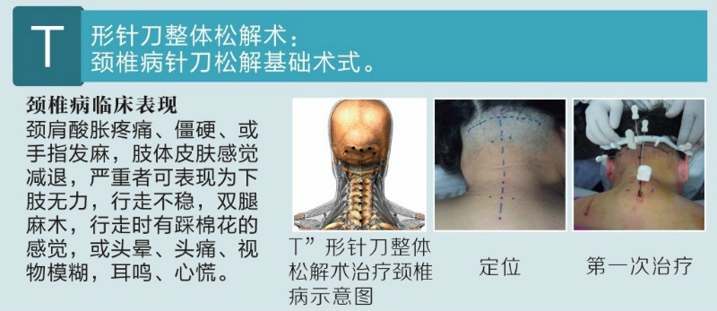 张天民T型针刀整体松解术