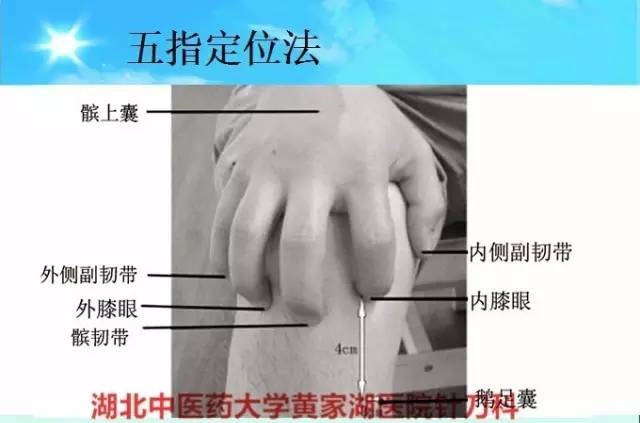 五指定位法针刀整体松解术治疗膝关节骨性关节炎