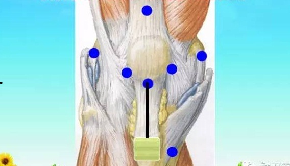 五指定位法针刀整体松解术治疗膝关节骨性关节炎