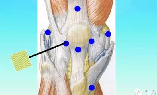 五指定位法针刀整体松解术治疗膝关节骨性关节炎