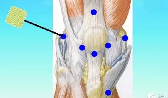 五指定位法针刀整体松解术治疗膝关节骨性关节炎