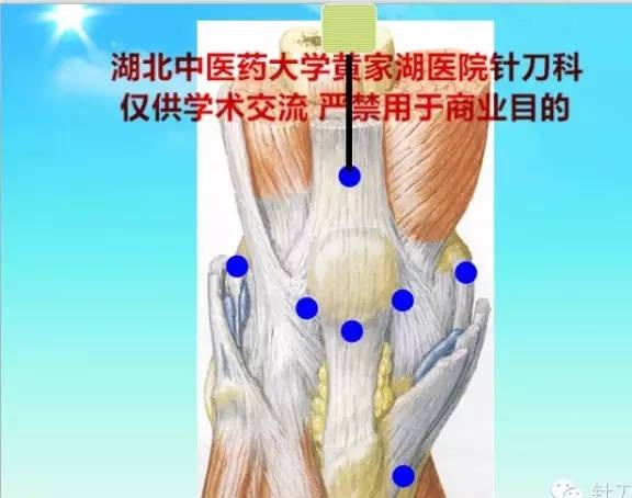 五指定位法针刀整体松解术治疗膝关节骨性关节炎