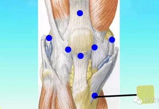 五指定位法针刀整体松解术治疗膝关节骨性关节炎