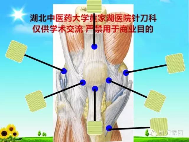 五指定位法针刀整体松解术治疗膝关节骨性关节炎