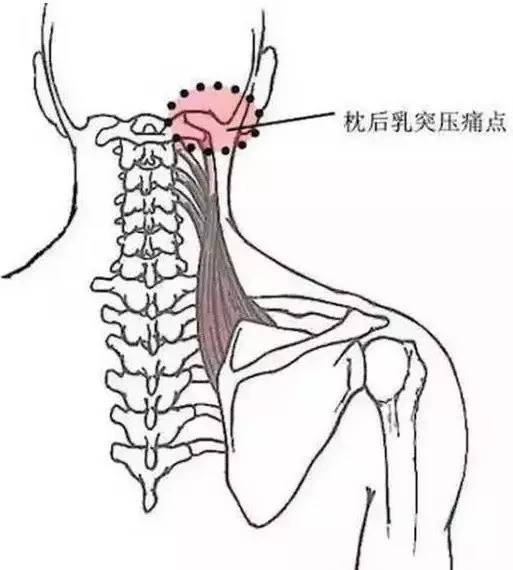 枕后乳突压痛点