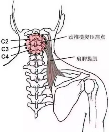 颈椎横突压痛点