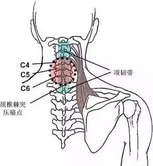 颈椎棘突压痛点