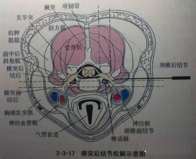 天民针刀肩胛提肌