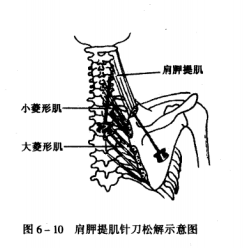 天民针刀肩胛提肌