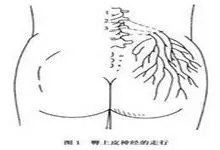 针刀治疗臀上皮神经痛