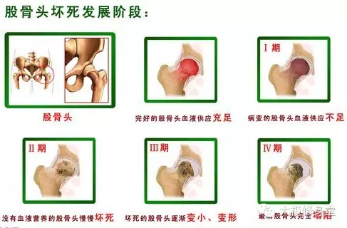 股骨头坏死发展阶段