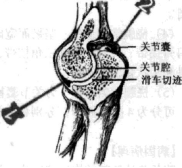 侧副韧带松解