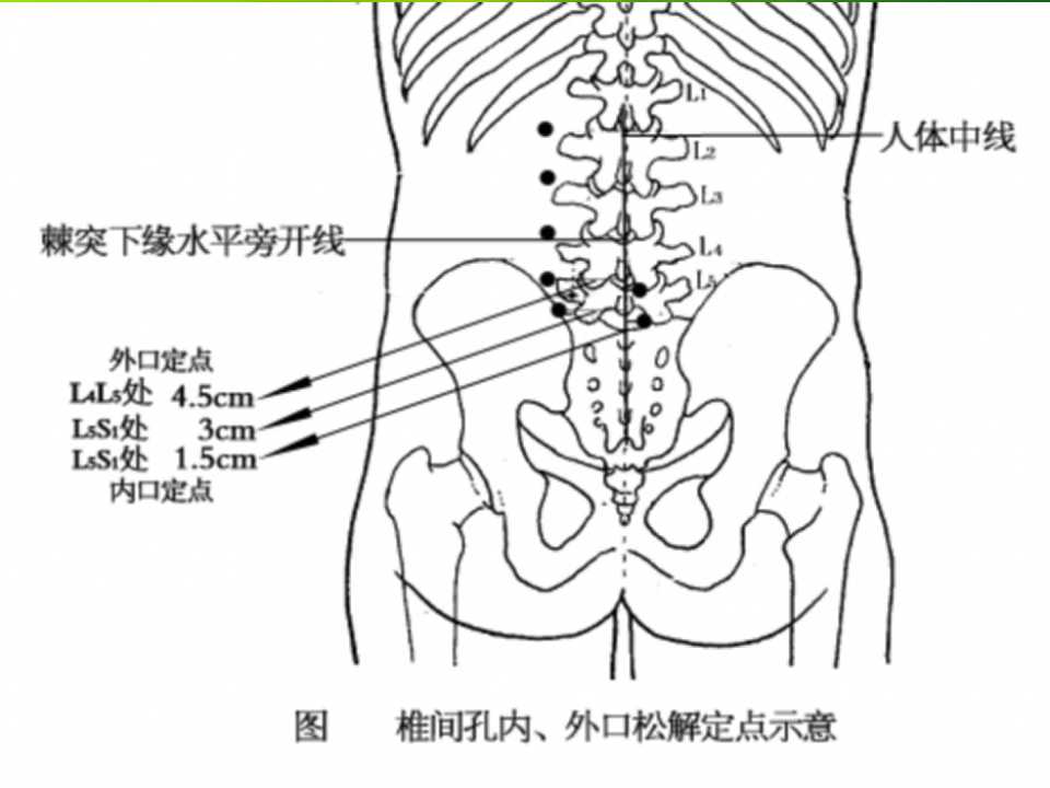 小针刀培训之腰椎横突的体表定位