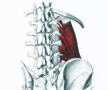 腰三横突综合症的针刀治疗