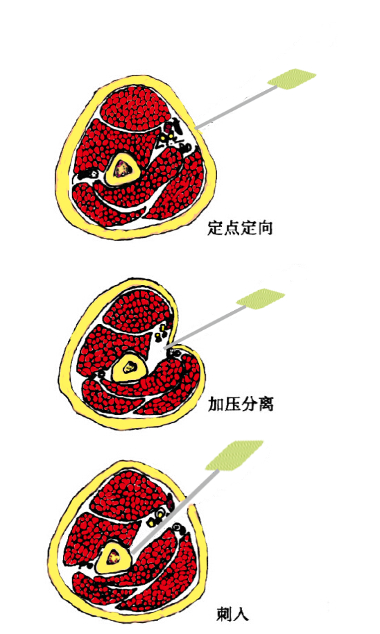 四步进针刀规程