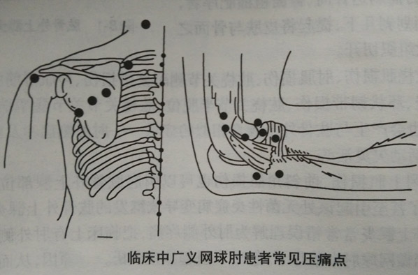 针刀治疗网球肘