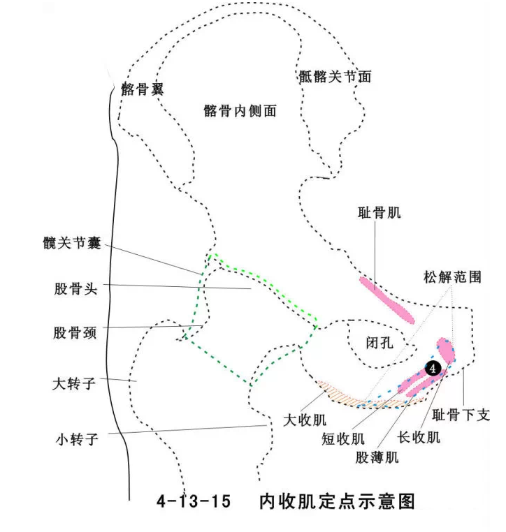 股骨头坏死针刀治疗精要