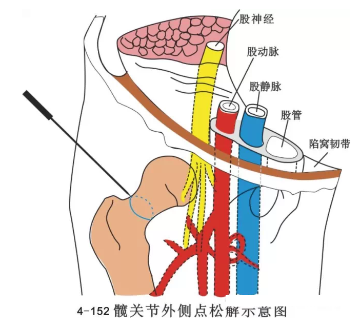 股骨头坏死针刀治疗精要