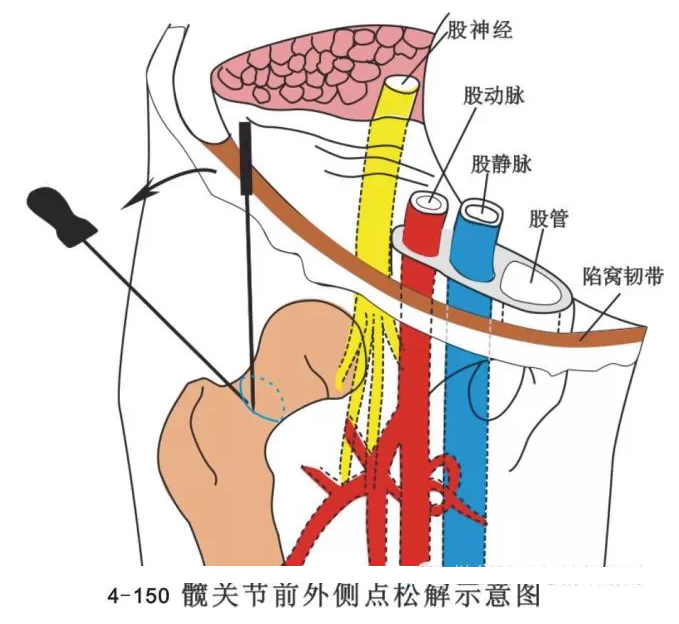 股骨头坏死针刀治疗精要