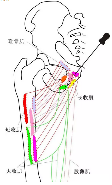 股骨头坏死针刀治疗精要