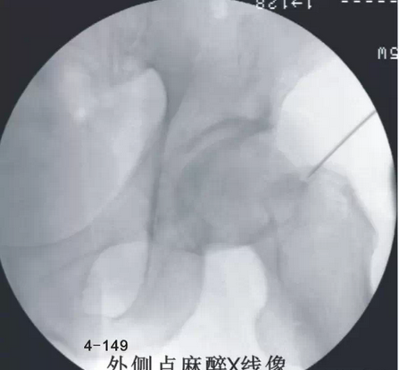 股骨头坏死针刀治疗精要