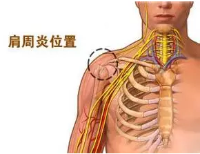 天民针刀治疗肩周炎疗效