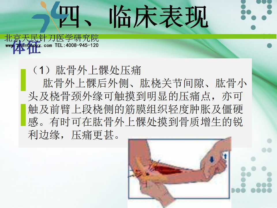 天民针刀专家王宗佼针刀治疗网球肘课件