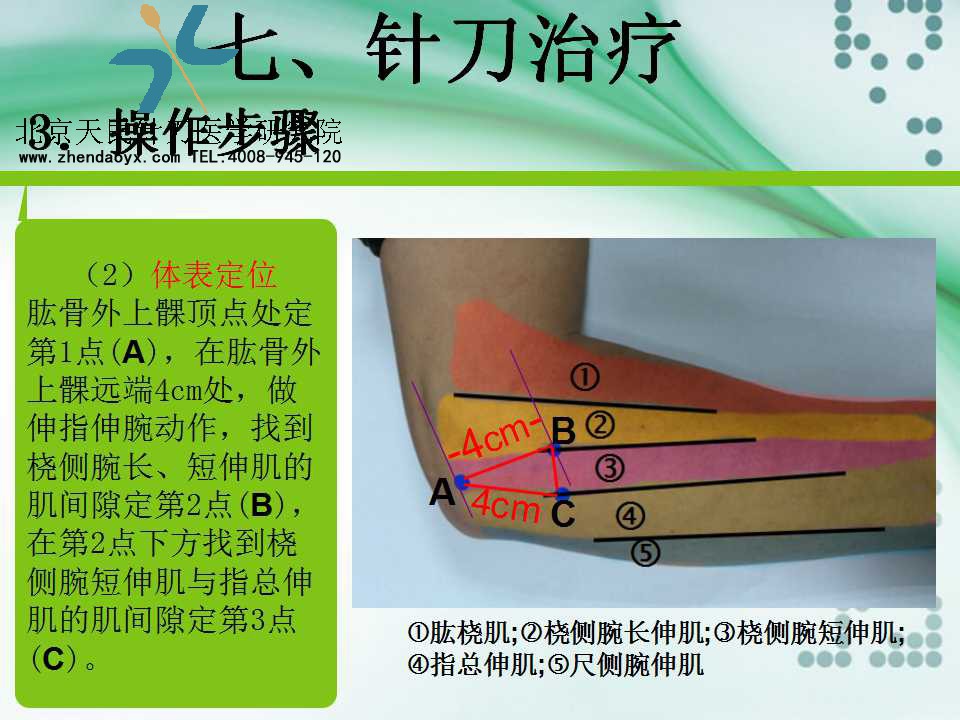 天民针刀专家王宗佼针刀治疗网球肘课件