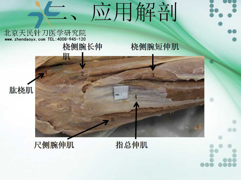 天民针刀专家王宗佼针刀治疗网球肘课件