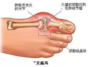 天民针刀治疗痛风