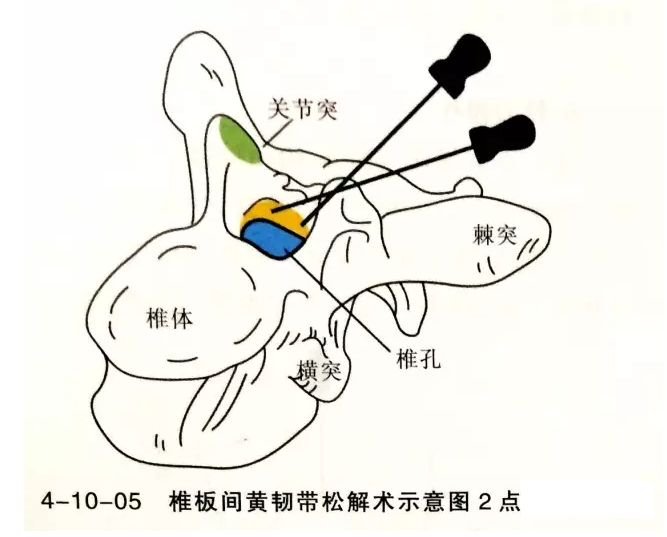 针刀治疗黄韧带肥厚骨化症图解