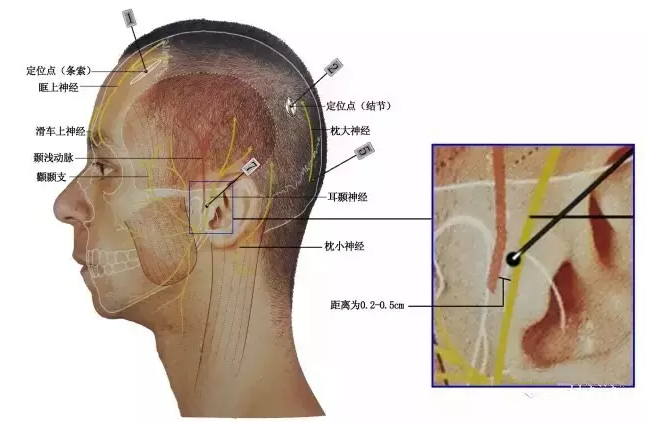 针刀治疗偏头痛