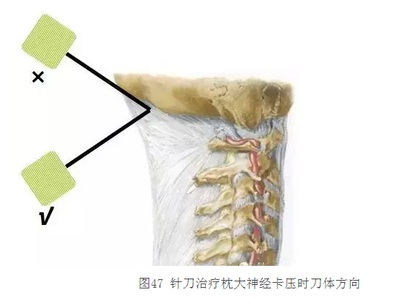 针刀治疗偏头痛