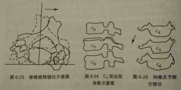 颈椎椎间关节错位