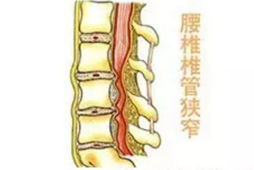 针刀腰椎管狭窄