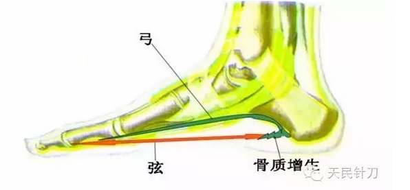 针刀治疗骨质增生的新认识及研究方向