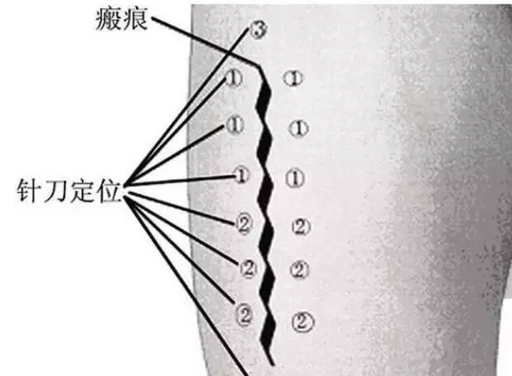 针刀美容