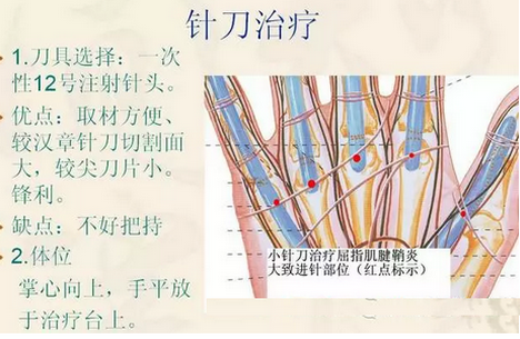 针刀松解屈指肌腱狭窄性腱鞘炎