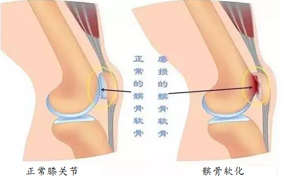 髌骨软化