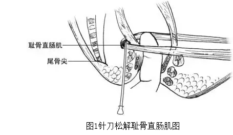 针刀治疗便秘