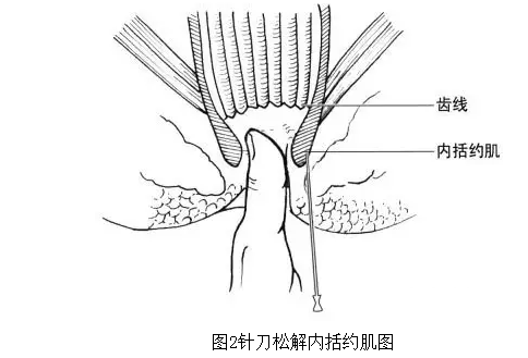 针刀治疗便秘