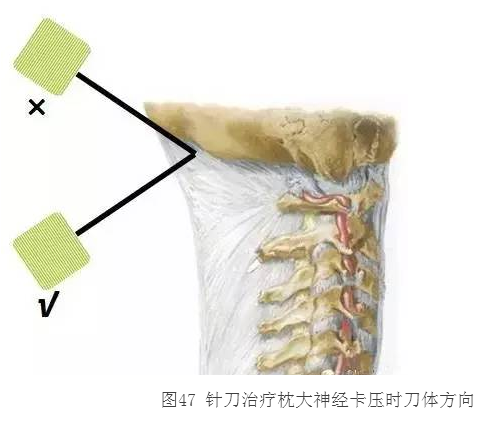 针刀治疗偏头疼