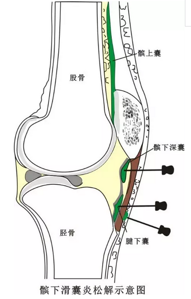 针刀治疗骨伤科颈肩腰腿痛疾病