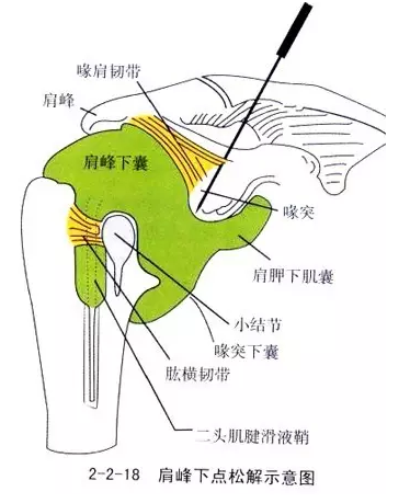 针刀治疗骨伤科颈肩腰腿痛疾病