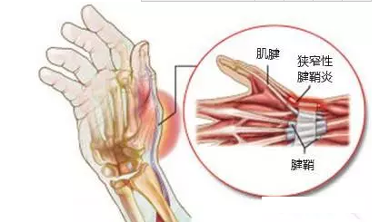 腱鞘炎与小针刀治疗