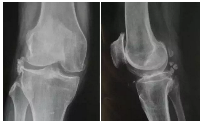22种引起膝关节疼痛的常见疾病