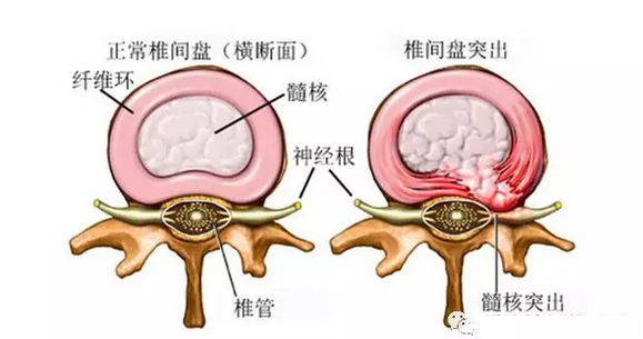 腰椎间盘突出会带来哪些危害呢？<