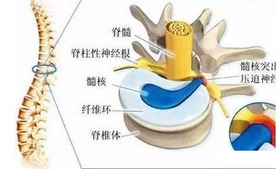 椎管内软组织损害性疼痛征象与检查 