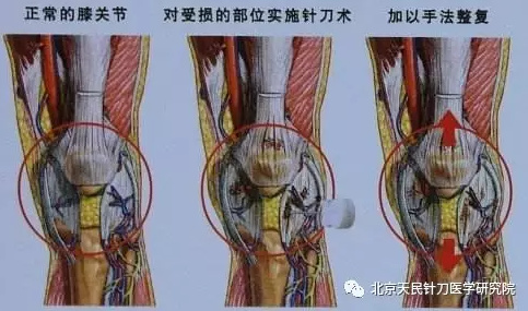 针刀松解髌下脂肪垫