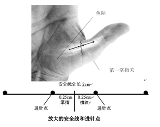 扳机拇指针刀松解术